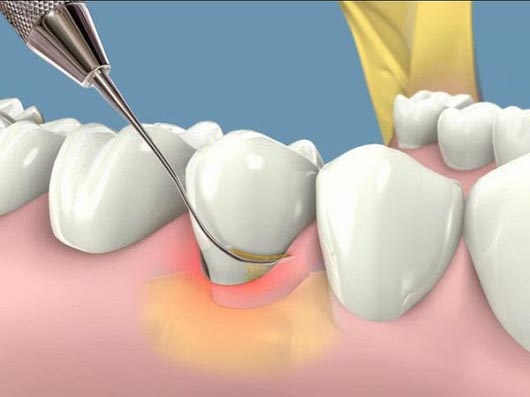 Periodontal Gum Therapy Periodontal Gum Therapy
