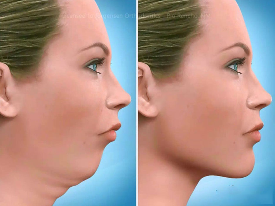 Jaw Surgery Jaw Surgery