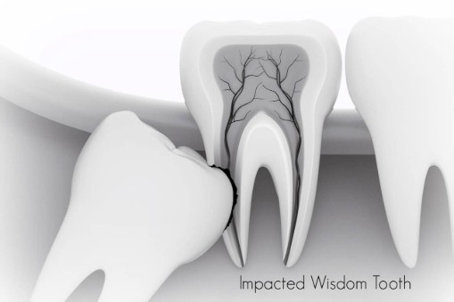 Impacted Wisdom Teeth Impacted Wisdom Teeth
