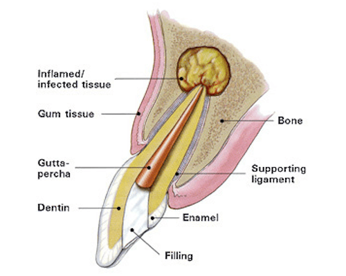 Apicoectomy Apicoectomy