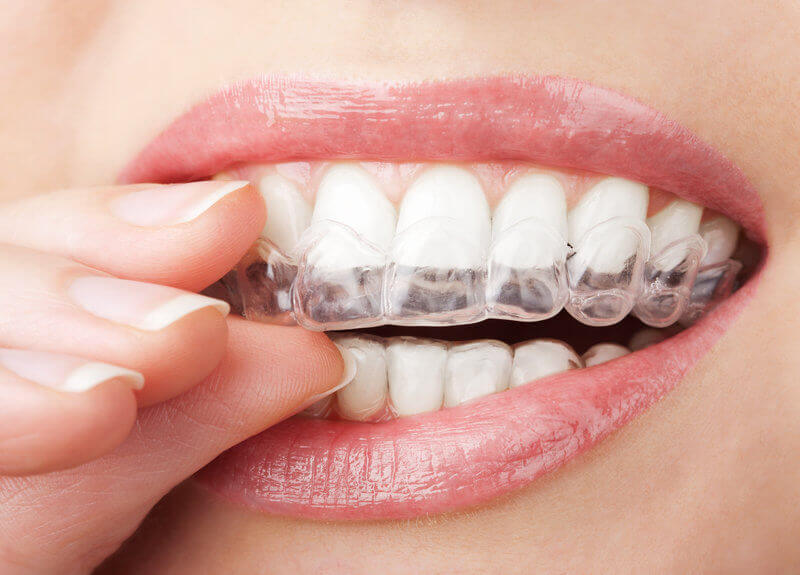 Invisalign treatment and benefits arlington dentist