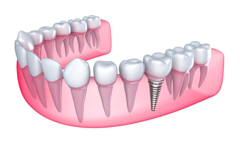 Complete guide to dental implants arlington ma