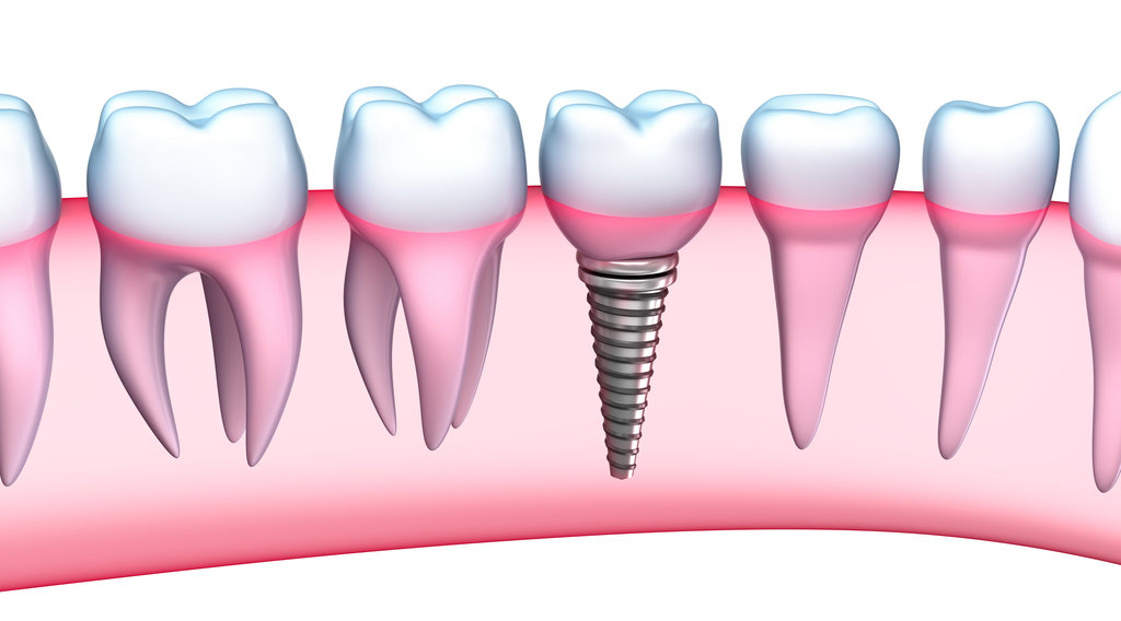 How long do dental implants last