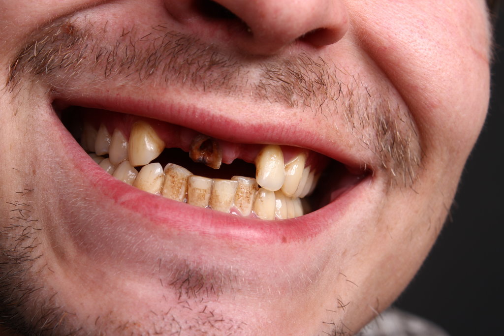Smoking and dental implants what you need to know